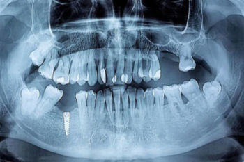 implantes dentales en Valencia