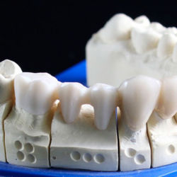 Prótesis dentales fijas Valencia