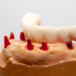 Prótesis sobre implantes Valencia