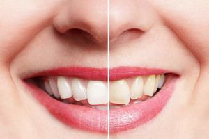 Blanqueamiento dental en Valencia